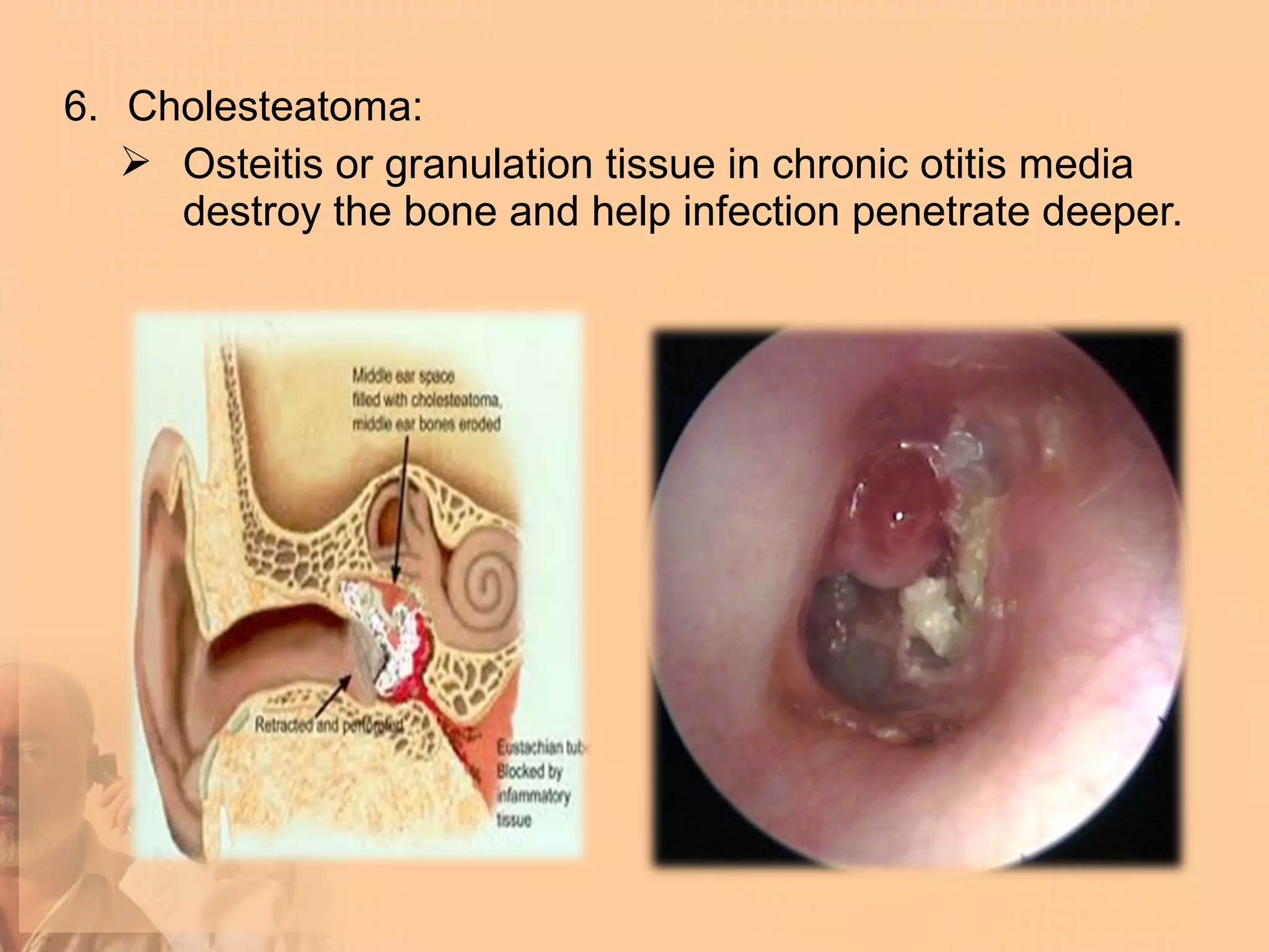 6. Cholesteatoma:
    Osteitis or granulation tissue in chronic otitis media
     destroy the bone and help infection penetrate deeper.
 