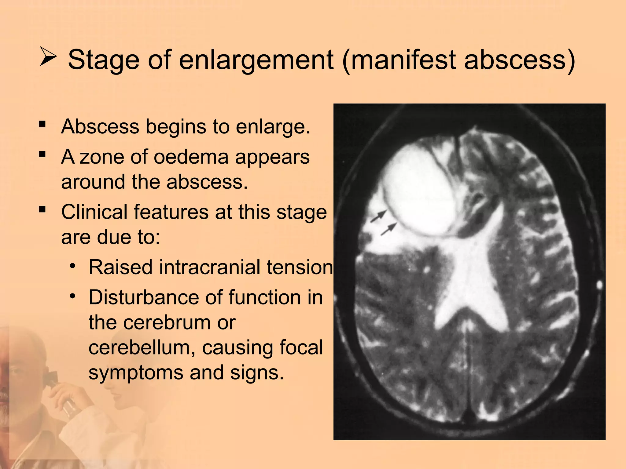  Stage of enlargement (manifest abscess)

 Abscess begins to enlarge.
 A zone of oedema appears
  around the abscess.
 Clinical features at this stage
  are due to:
   • Raised intracranial tension.
   • Disturbance of function in
     the cerebrum or
     cerebellum, causing focal
     symptoms and signs.
 