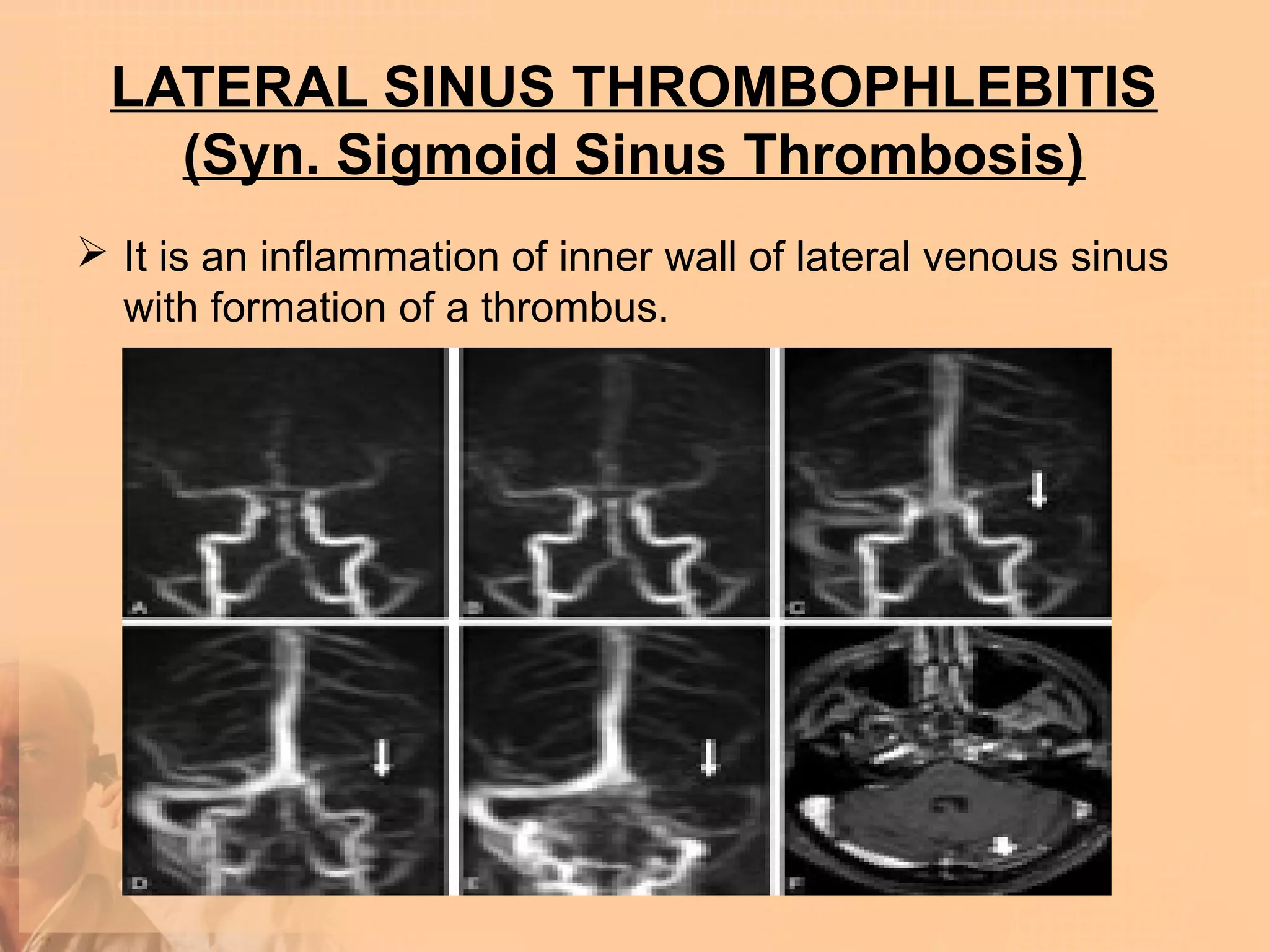 LATERAL SINUS THROMBOPHLEBITIS
   (Syn. Sigmoid Sinus Thrombosis)
 It is an inflammation of inner wall of lateral venous sinus
  with formation of a thrombus.
 