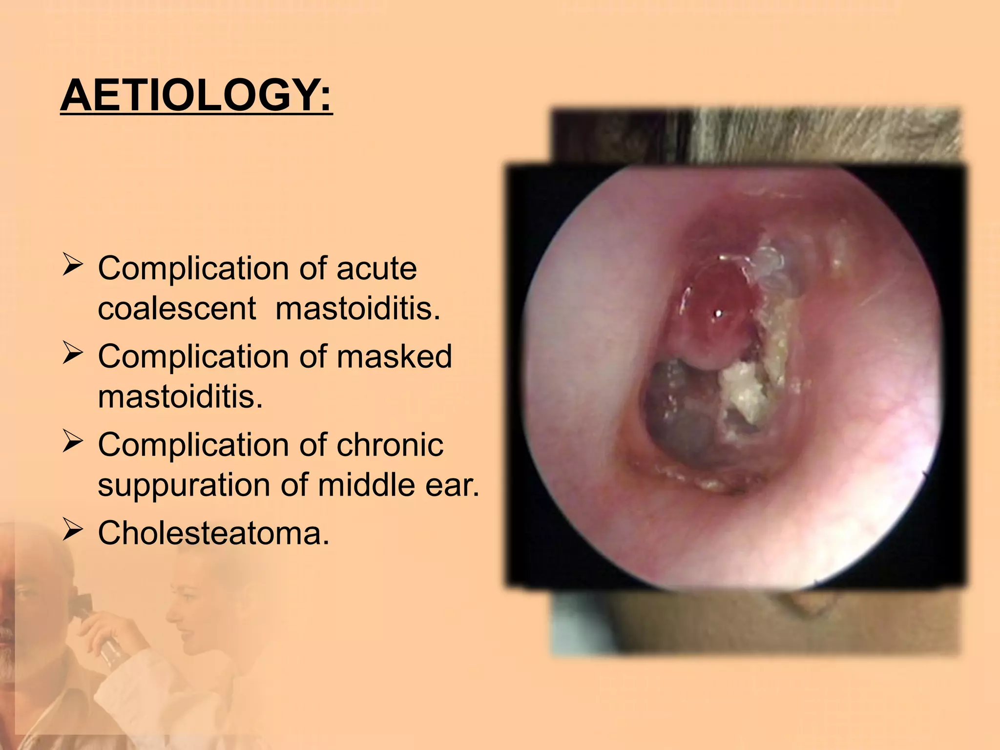 AETIOLOGY:


 Complication of acute
  coalescent mastoiditis.
 Complication of masked
  mastoiditis.
 Complication of chronic
  suppuration of middle ear.
 Cholesteatoma.
 