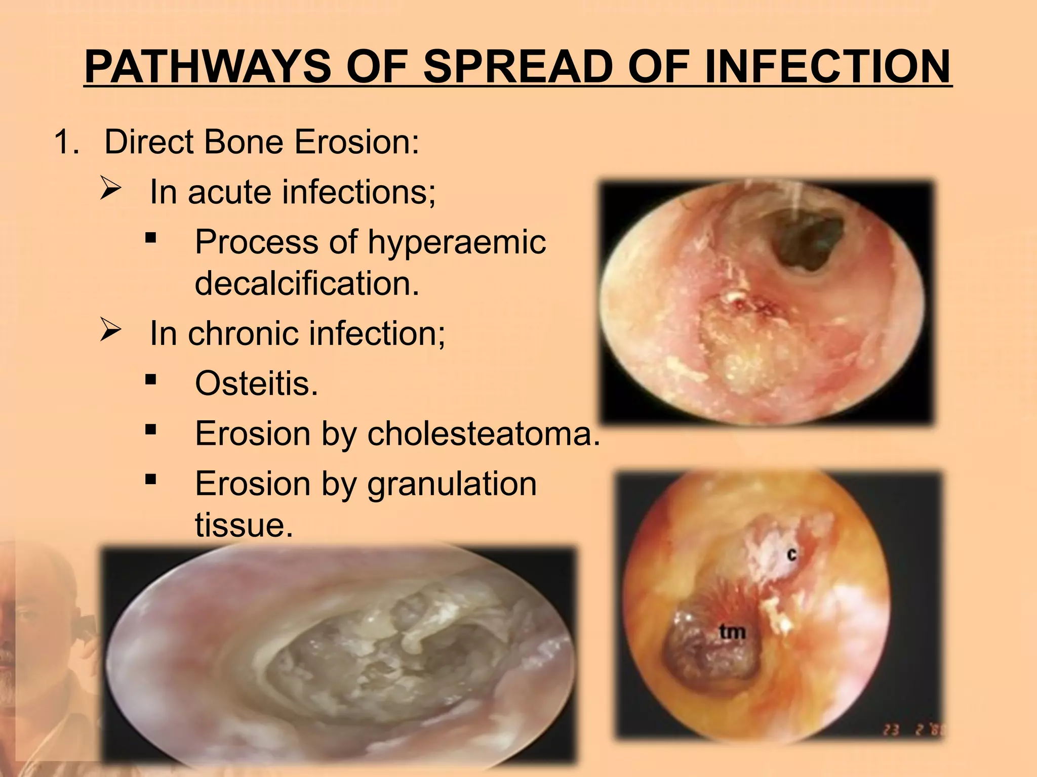 PATHWAYS OF SPREAD OF INFECTION
1. Direct Bone Erosion:
    In acute infections;
       Process of hyperaemic
         decalcification.
    In chronic infection;
       Osteitis.
       Erosion by cholesteatoma.
       Erosion by granulation
         tissue.
 