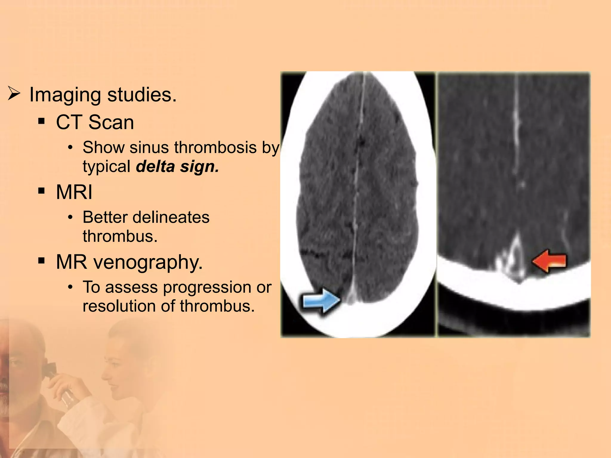  Imaging studies.
    CT Scan
      • Show sinus thrombosis by
        typical delta sign.
    MRI
      • Better delineates
        thrombus.
    MR venography.
      • To assess progression or
        resolution of thrombus.
 