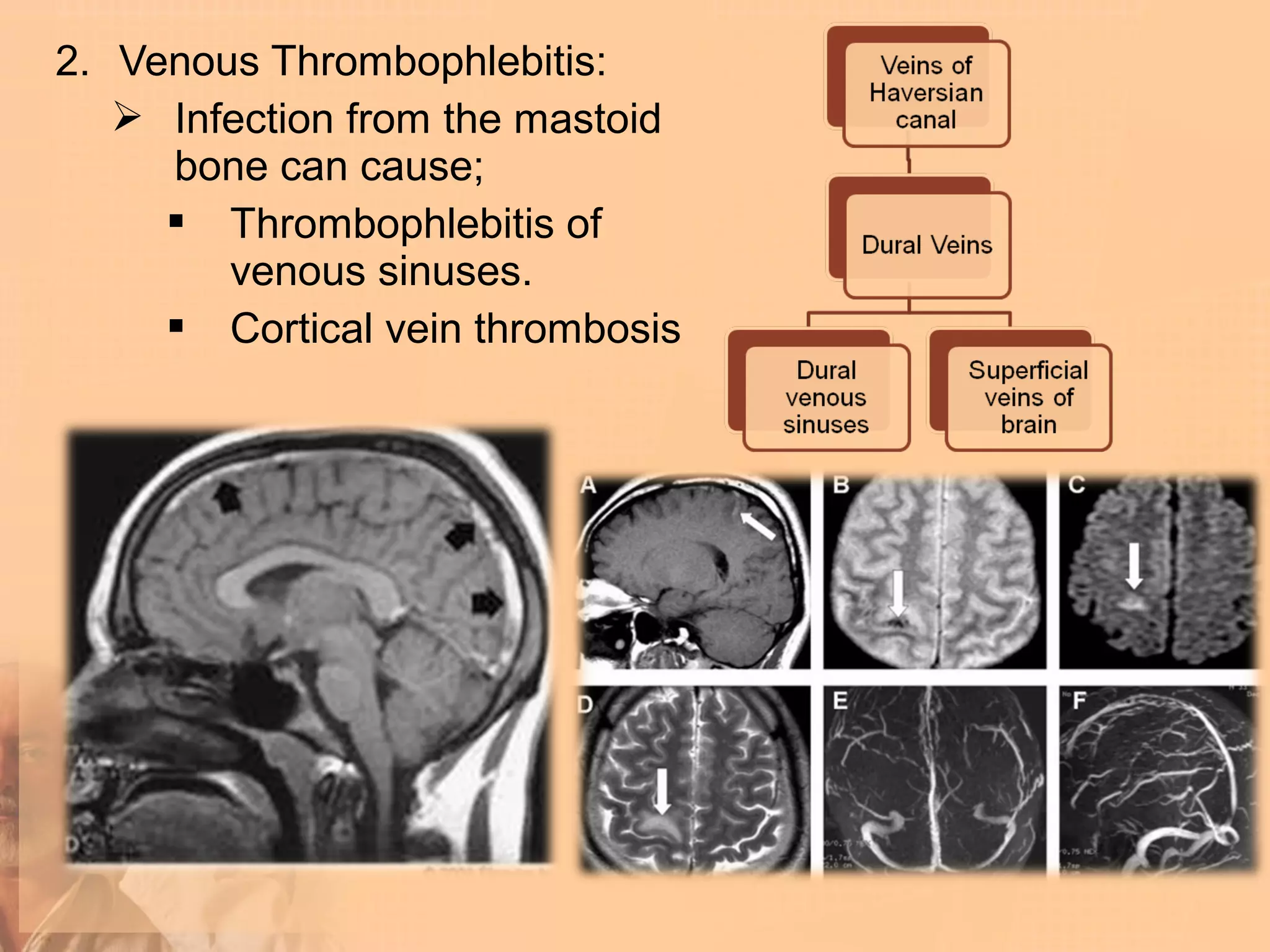 2. Venous Thrombophlebitis:
    Infection from the mastoid
     bone can cause;
      Thrombophlebitis of
        venous sinuses.
      Cortical vein thrombosis
 