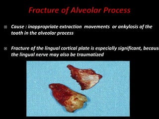  Cause : inappropriate extraction movements or ankylosis of the
tooth in the alveolar process
 Fracture of the lingual cortical plate is especially significant, because
the lingual nerve may also be traumatized
 
