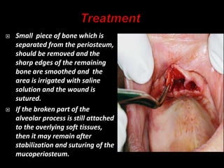  Small piece of bone which is
separated from the periosteum,
should be removed and the
sharp edges of the remaining
bone are smoothed and the
area is irrigated with saline
solution and the wound is
sutured.
 If the broken part of the
alveolar process is still attached
to the overlying soft tissues,
then it may remain after
stabilization and suturing of the
mucoperiosteum.
 