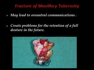  May lead to oroantral communications .
 Create problems for the retention of a full
denture in the future.
 