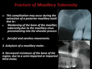  This complication may occur during the
extraction of a posterior maxillary tooth
due to :
1. Weakening of the bone of the maxillary
tuberosity,due to the maxillary sinus
pneumatizing into the alveolar process.
2. forceful and careless movements.
3. Ankylosis of a maxillary molar .
4. Decreased resistance of the bone of the
region, due to a semi-impacted or impacted
third molar.
 