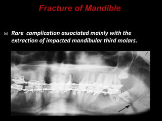  Rare complication associated mainly with the
extraction of impacted mandibular third molars.
 