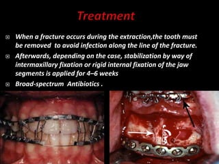 When a fracture occurs during the extraction,the tooth must
be removed to avoid infection along the line of the fracture.
 Afterwards, depending on the case, stabilization by way of
intermaxillary fixation or rigid internal fixation of the jaw
segments is applied for 4–6 weeks
 Broad-spectrum Antibiotics .
 