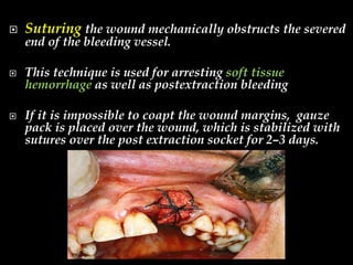 Suturing the wound mechanically obstructs the severed
end of the bleeding vessel.
 This technique is used for arresting soft tissue
hemorrhage as well as postextraction bleeding
 If it is impossible to coapt the wound margins, gauze
pack is placed over the wound, which is stabilized with
sutures over the post extraction socket for 2–3 days.
 