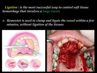 Ligation : is the most successful way to control soft tissue
hemorrhage that involves a large vessel.
 Hemostat is used to clamp and ligate the vessel within a few
minutes, without ligation of the tissues
 