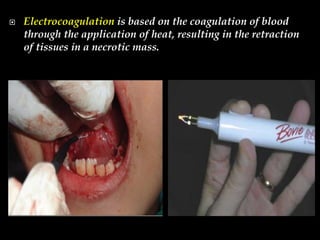  Electrocoagulation is based on the coagulation of blood
through the application of heat, resulting in the retraction
of tissues in a necrotic mass.
 