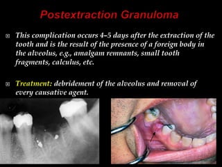  This complication occurs 4–5 days after the extraction of the
tooth and is the result of the presence of a foreign body in
the alveolus, e.g., amalgam remnants, small tooth
fragments, calculus, etc.
 Treatment: debridement of the alveolus and removal of
every causative agent.
 