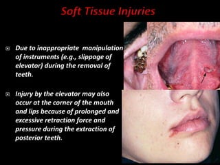  Due to inappropriate manipulation
of instruments (e.g., slippage of
elevator) during the removal of
teeth.
 Injury by the elevator may also
occur at the corner of the mouth
and lips because of prolonged and
excessive retraction force and
pressure during the extraction of
posterior teeth.
 