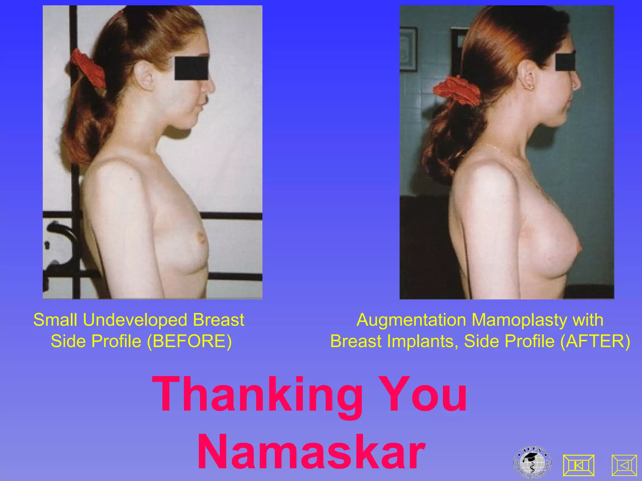 Small Undeveloped Breast
Side Profile (BEFORE)
Augmentation Mamoplasty with
Breast Implants, Side Profile (AFTER)
Thanking You
Namaskar
 