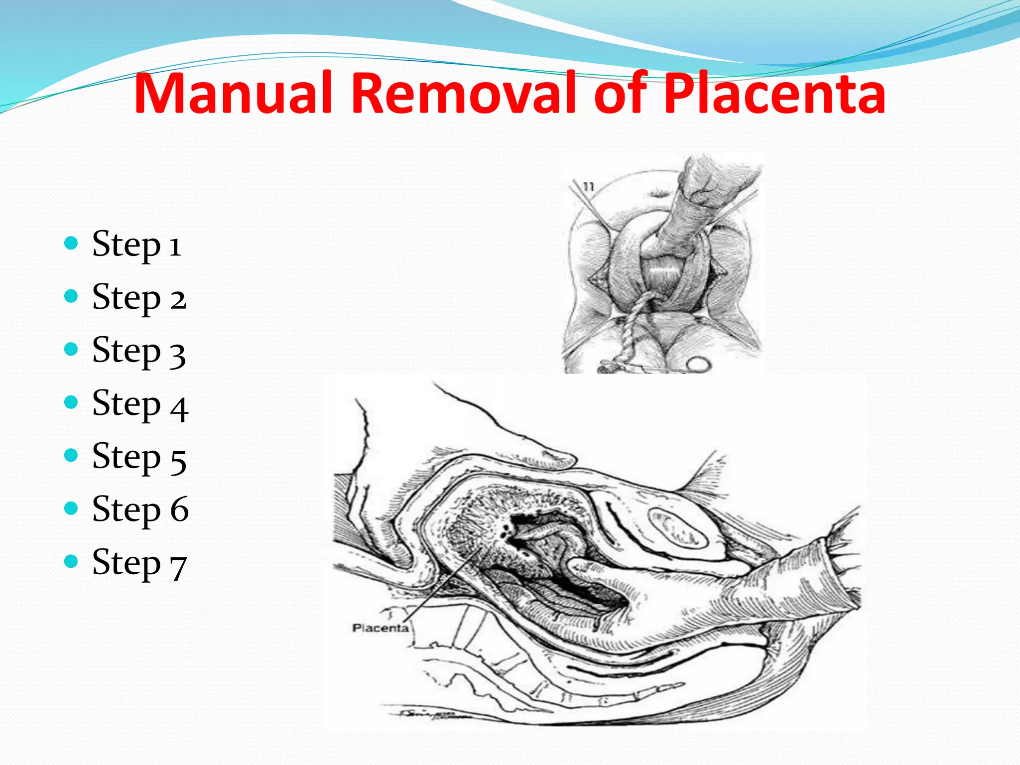Manual Removal of Placenta
 Step 1
 Step 2
 Step 3
 Step 4
 Step 5
 Step 6
 Step 7
 