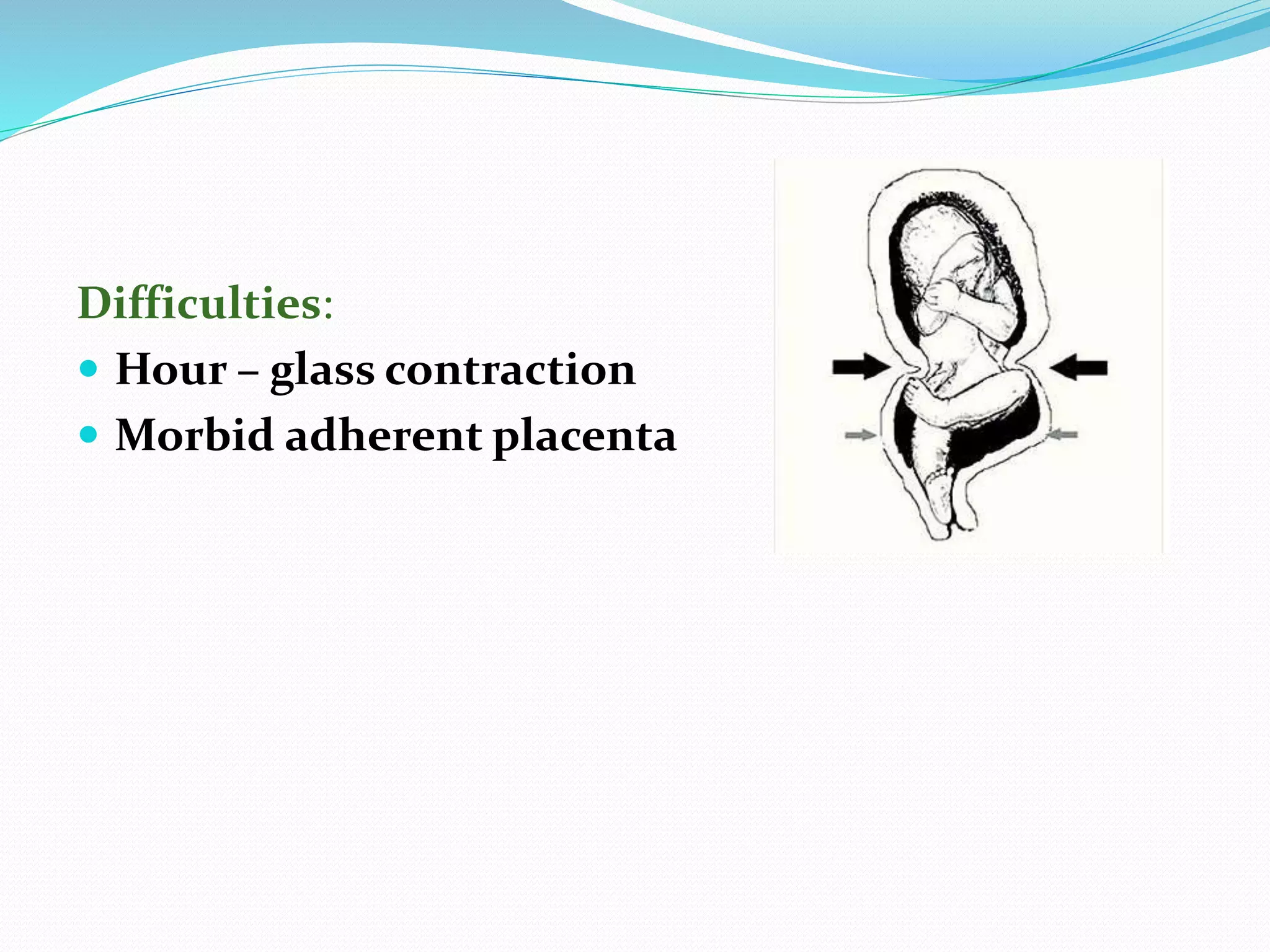 Difficulties:
 Hour – glass contraction
 Morbid adherent placenta
 