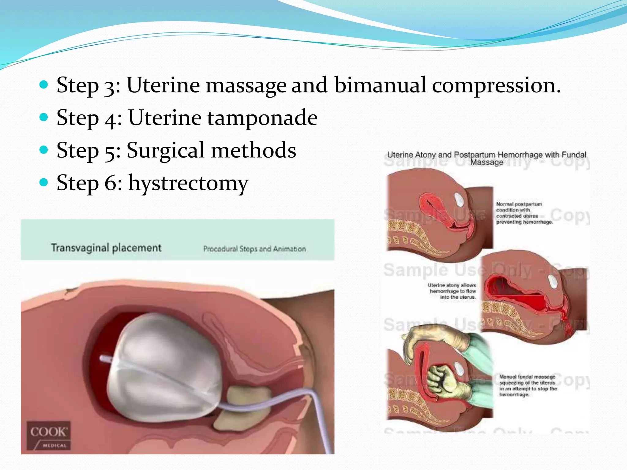  Step 3: Uterine massage and bimanual compression.
 Step 4: Uterine tamponade
 Step 5: Surgical methods
 Step 6: hystrectomy
 