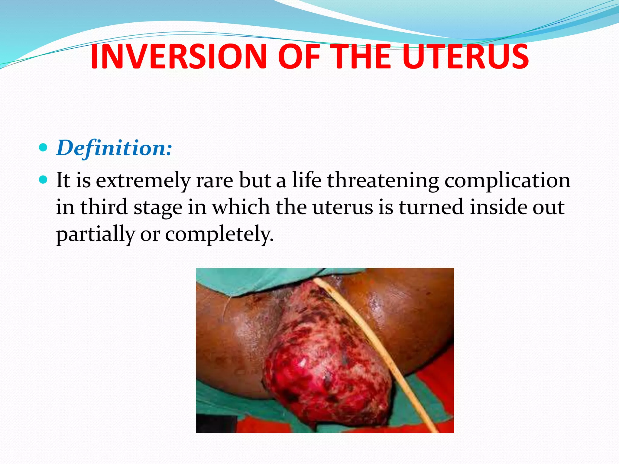 INVERSION OF THE UTERUS
 Definition:
 It is extremely rare but a life threatening complication
in third stage in which the uterus is turned inside out
partially or completely.
 