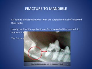 FRACTURE TO MANDIBLE
Associated almost exclusively with the surgical removal of impacted
third molar.
Usually result of th...