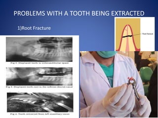 PROBLEMS WITH A TOOTH BEING EXTRACTED
1)Root Fracture
2)Root Displacement
3)Tooth loss into Phayrnx
 