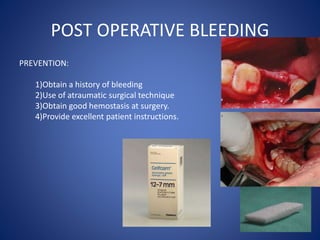 POST OPERATIVE BLEEDING
PREVENTION:
1)Obtain a history of bleeding
2)Use of atraumatic surgical technique
3)Obtain good he...