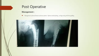 Post Operative
Management :
 Management is planned based on fracture pattern. Options include plating , cerclage wiring with bone grafting .
 