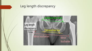Leg length discrepancy
 