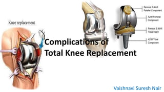 Complications of 
Total Knee Replacement 
Vaishnavi Suresh Nair 
 