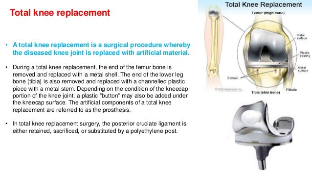 Knee replacement surgery risk