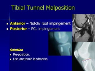 Tibial Tunnel Malposition
 Anterior – Notch/ roof impingement
 Posterior – PCL impingement
Solution
 Re-position.
 Use anatomic landmarks
 