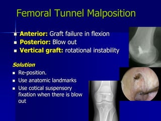Femoral Tunnel Malposition
 Anterior: Graft failure in flexion
 Posterior: Blow out
 Vertical graft: rotational instability
Solution
 Re-position.
 Use anatomic landmarks
 Use cotical suspensory
fixation when there is blow
out
 