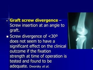 • Graft screw divergence –
Screw insertion at an angle to
graft.
 Screw divergence of <30º
does not seem to have a
significant effect on the clinical
outcome if the fixation
strength at time of operation is
tested and found to be
adequate. Dworsky et al.
 