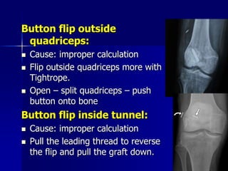 Button flip outside
quadriceps:
 Cause: improper calculation
 Flip outside quadriceps more with
Tightrope.
 Open – split quadriceps – push
button onto bone
Button flip inside tunnel:
 Cause: improper calculation
 Pull the leading thread to reverse
the flip and pull the graft down.
 
