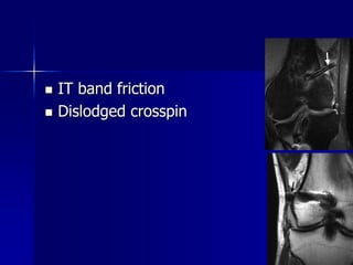  IT band friction
 Dislodged crosspin
 