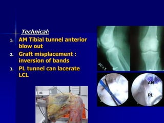 Technical:
1. AM Tibial tunnel anterior
blow out
2. Graft misplacement :
inversion of bands
3. PL tunnel can lacerate
LCL
AM
PL
PL
 