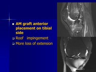  AM graft anterior
placement on tibial
side
 Roof impingement
 More loss of extension
 