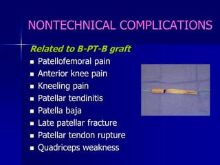 NONTECHNICAL COMPLICATIONS
Related to B-PT-B graft
 Patellofemoral pain
 Anterior knee pain
 Kneeling pain
 Patellar tendinitis
 Patella baja
 Late patellar fracture
 Patellar tendon rupture
 Quadriceps weakness
 