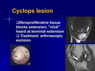 Cyclops lesion
fibroproliferative tissue
blocks extension; "click"
heard at terminal extension
 Treatment: arthroscopic
excision
 