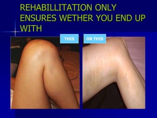 REHABILLITATION ONLY
ENSURES WETHER YOU END UP
WITH
THIS OR THIS
 