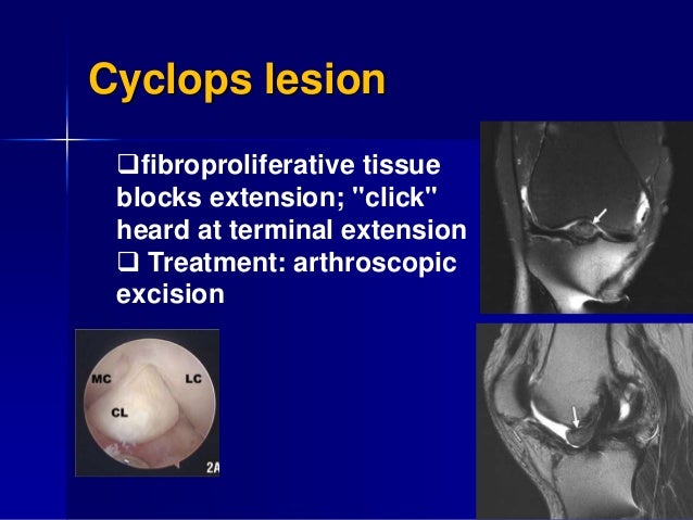 acl cyclops lesion complications arthroscopic