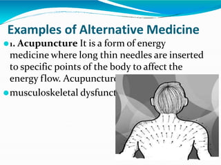 Examples of Alternative Medicine
⚫1. Acupuncture It is a form of energy
medicine where long thin needles are inserted
to specific points of the body to affect the
energy flow. Acupuncture is believed to treat
⚫musculoskeletal dysfunctions.
 