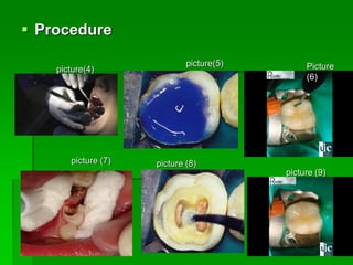 Compomers materials | PDF