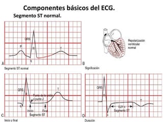 Componentes básicos del ECG.
Segmento ST normal.
 