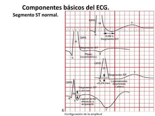 Componentes básicos del ECG.
Segmento ST normal.
 