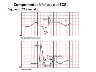 Componentes básicos del ECG.
Segmento ST anómalo.
 