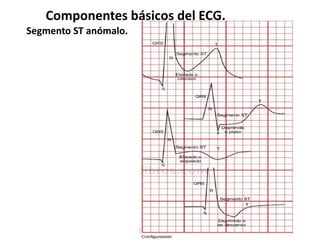 Componentes básicos del ECG.
Segmento ST anómalo.
 