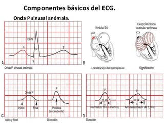 Componentes básicos del ECG.
Onda P sinusal anómala.
 