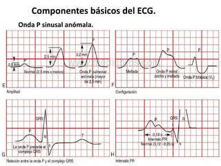 Componentes básicos del ECG.
Onda P sinusal anómala.
 