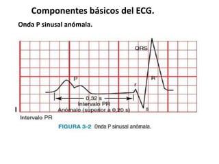 Componentes básicos del ECG.
Onda P sinusal anómala.
 